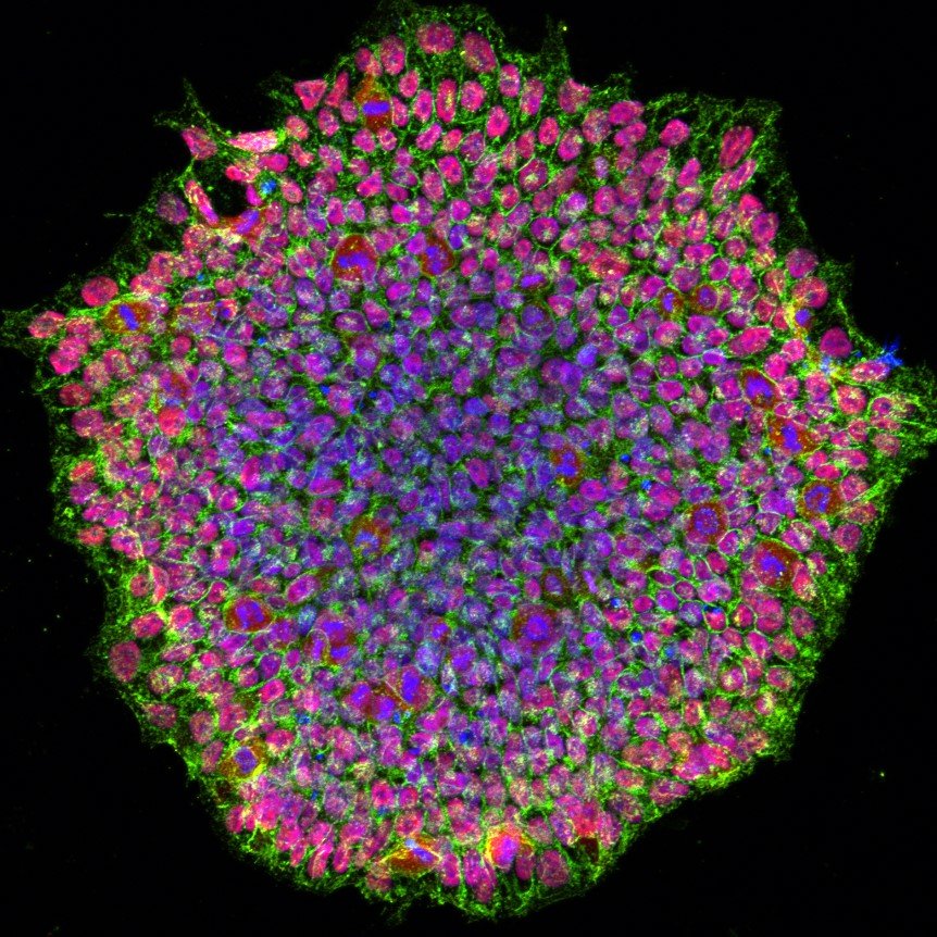 Immagine al microscopio a fluorescenza di una colonia di cellule staminali pluripotenti indotte, con marcatori proteici in verde e magenta e nuclei in blu